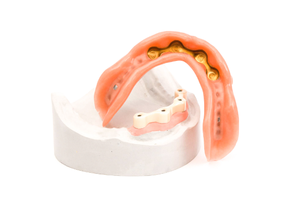 Pauli Zahntechnik Implantate und Stege Pauli Zahntechnik Implantate und Stege